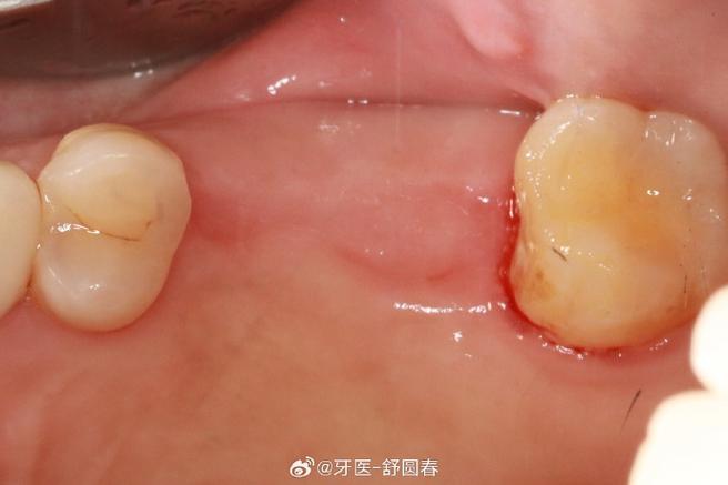 种植即刻修复 舒医生的诊疗日常与医学匠心